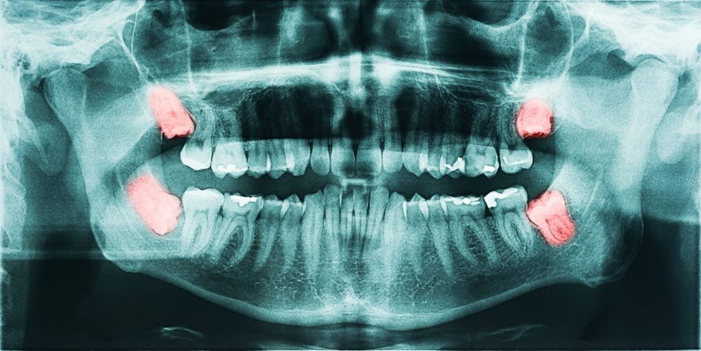 dental x-ray with wisdom teeth highlighted in pink