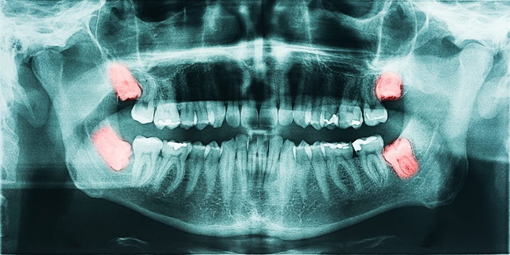 Dental Tooth X Ray Visualize Diseases Of Impacted Wisdom Teeth