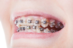 Dental Braces Straightening Your Teeth - Aridrie Springs Dental