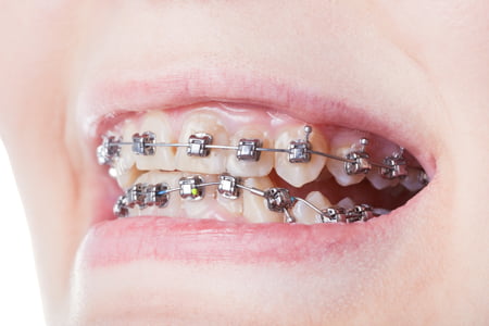 Kesteven Dental Care ClearLine vs Traditional Braces-Pros and Cons