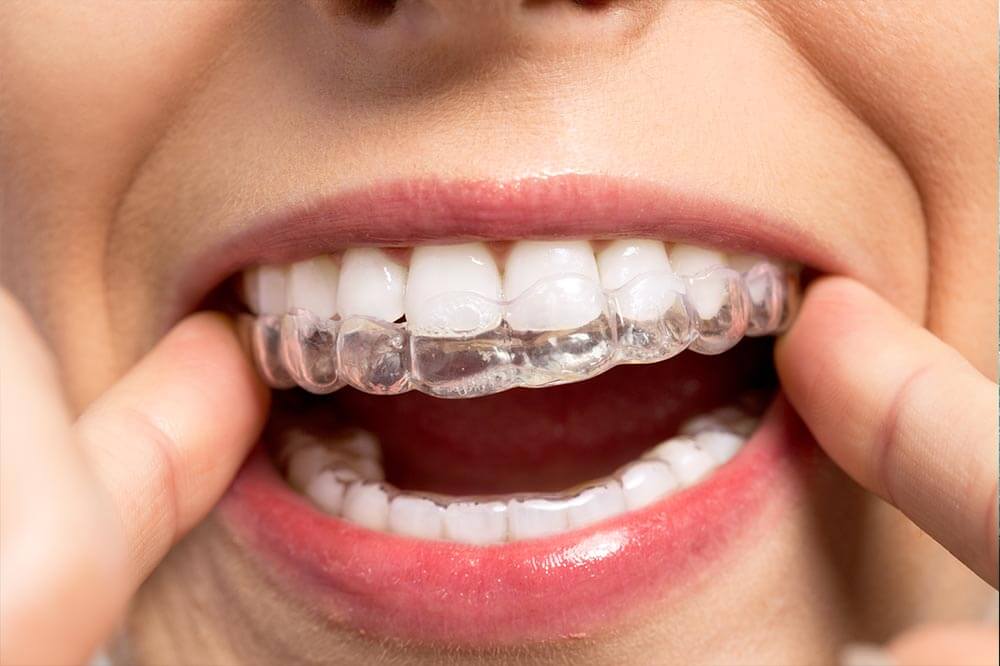 Invisalign upper aligner - Invisalign treatment | Invisalign clear aligners in Airdrie