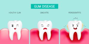 clipart stages of gum disease