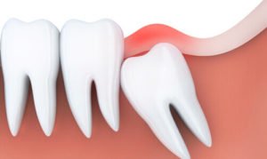 Wisdom Teeth Removal - Airdrie Springs Dental