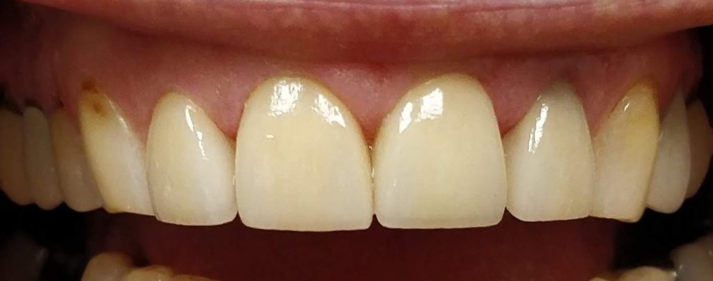filling-scaled treatment by airdrie dentist