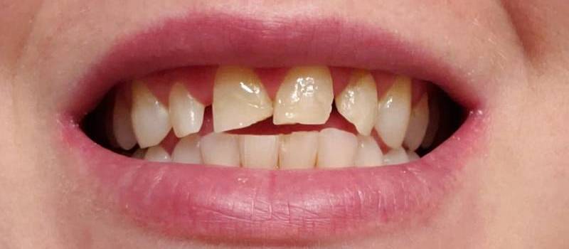 Smile Reveal #1 - Airdrie Springs Dental