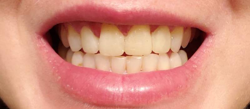 Smile Reveal #2 - Airdrie Springs Dental