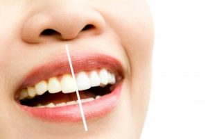 Common Teeth Whitening Mistakes You Should Avoid - Airdrie Springs Dental