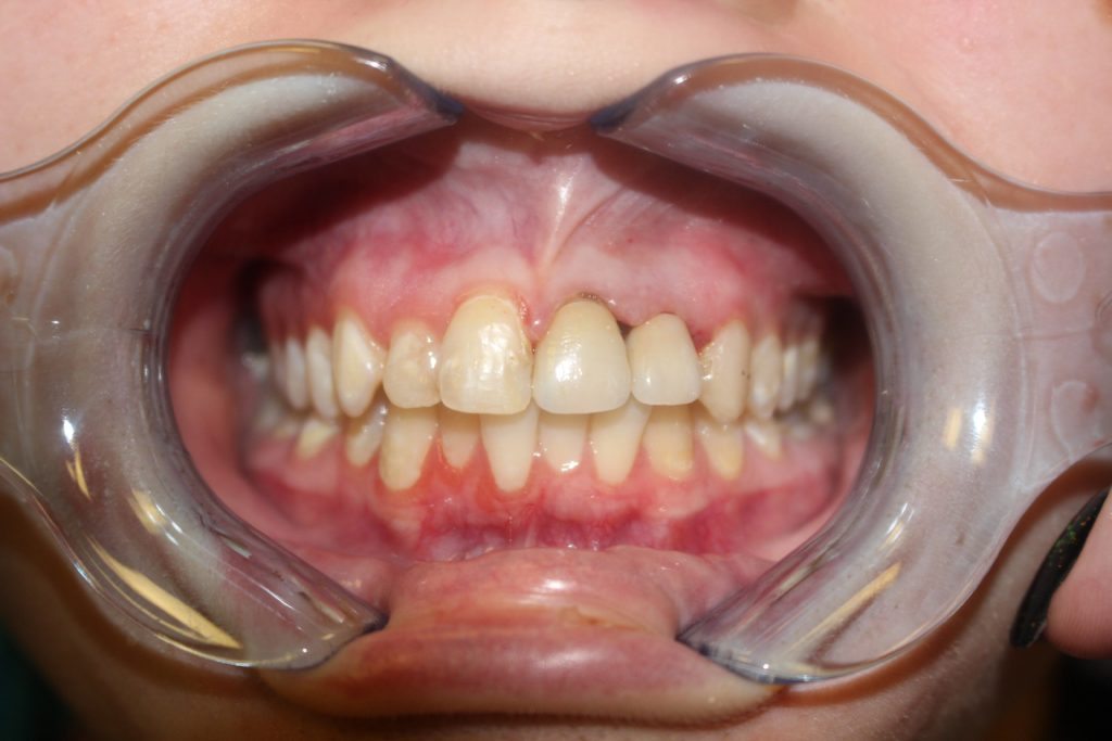 airdrie dentist dental crown after image