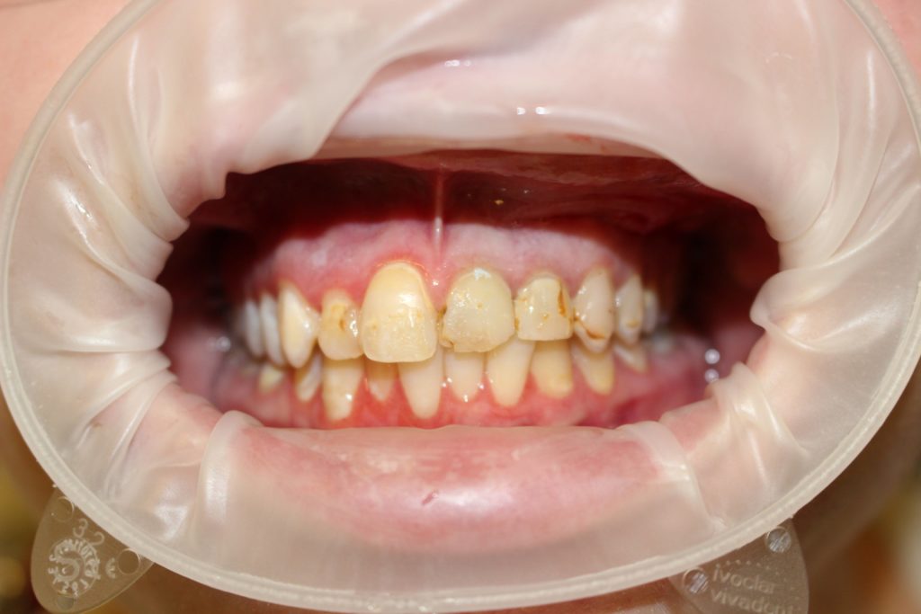 airdrie dentist dental crown before image