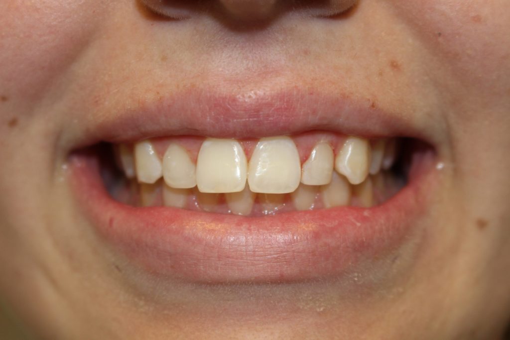 anterior fillings after image