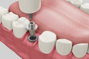 dental implants in Airdrie