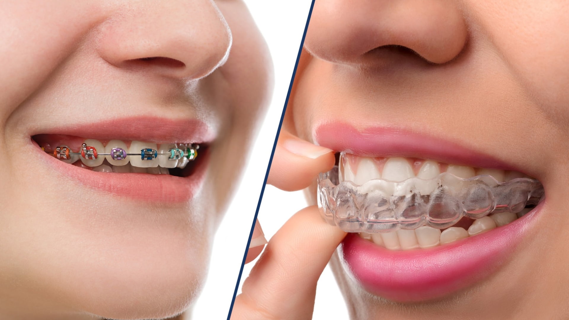 Braces vs Aligners: Which one to Choose
