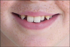 Malformed Teeth Airdrie Alberta