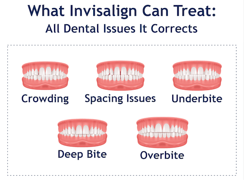 Invisalign Clear Teeth Straighteners