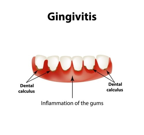 Gingivitis (Gum Disease or Periodontal Disease) Signs, Symptoms, Cause and Cure