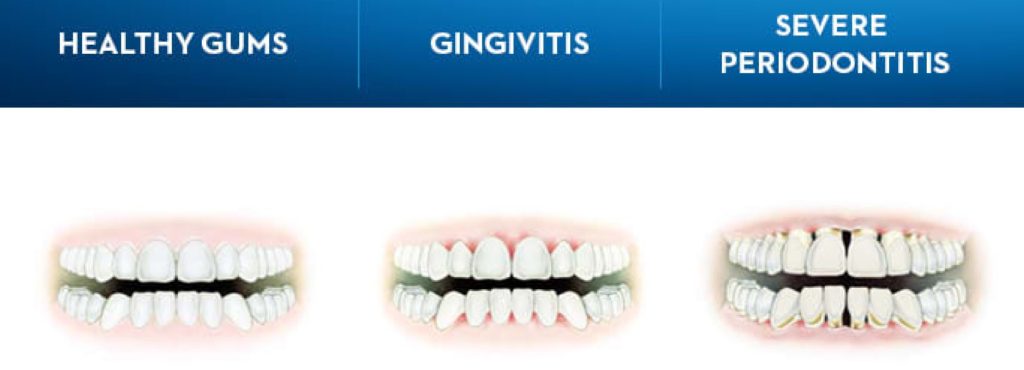 Gingivitis (Gum Disease or Periodontal Disease) Signs, Symptoms, Cause and Cure