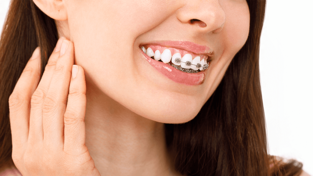 Cosmetic dental treatments: straighten your teeth with nearly invisible  braces - Mississauga Dentist & Dental Office - Jauhal Dental
