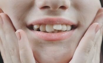 Maintain Your Invisalign Clear Aligners in Airdrie AB