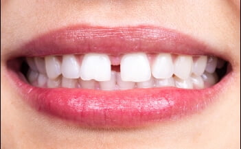 Gaps In The Teeth best for Invisalign Treatment