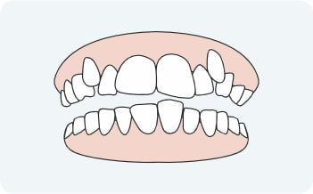 Overcrowded teeth orthodontics