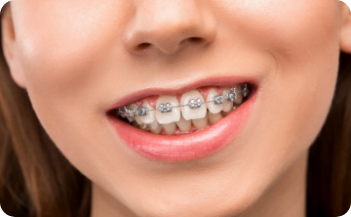 Traditional Metal Braces orthodontics