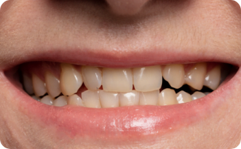 Yellow, Stained, or Discolored Teeth