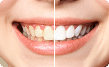 Whitening of Teeth