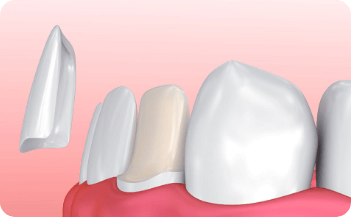 Dental Veneer