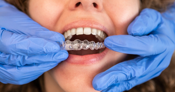 factors that make you a good candidate for Invisalign